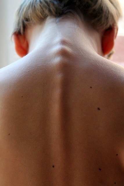 Back view of a person showing spine alignment and skin texture, highlighting potential injuries from truck accidents.